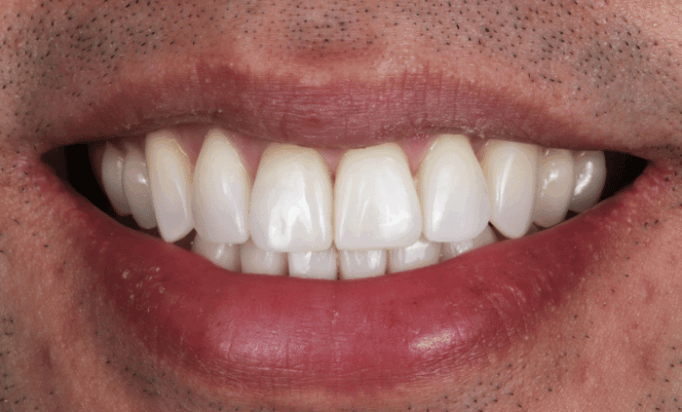 After -Bond Dental London