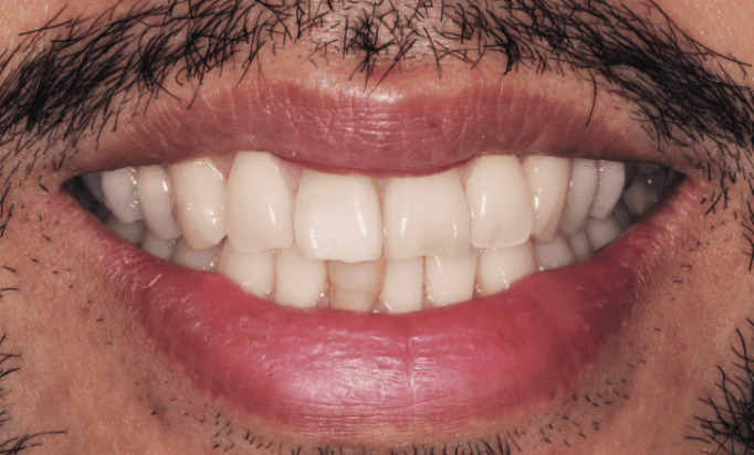 Before - Bond Dental London