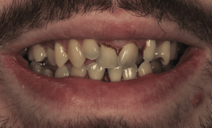 Before - Bond Dental London