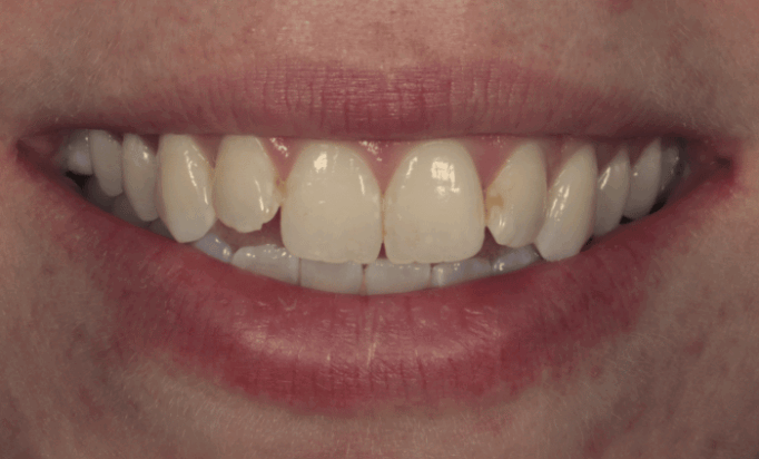 Before - Bond Dental London