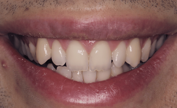 Before - Bond Dental London