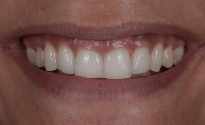 Before - Bond Dental London