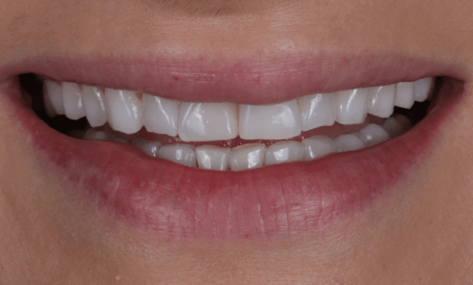 Before - Bond Dental London