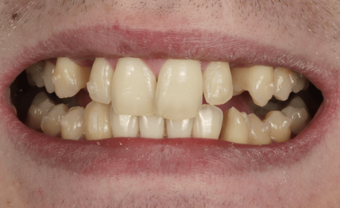 Before - Bond Dental London